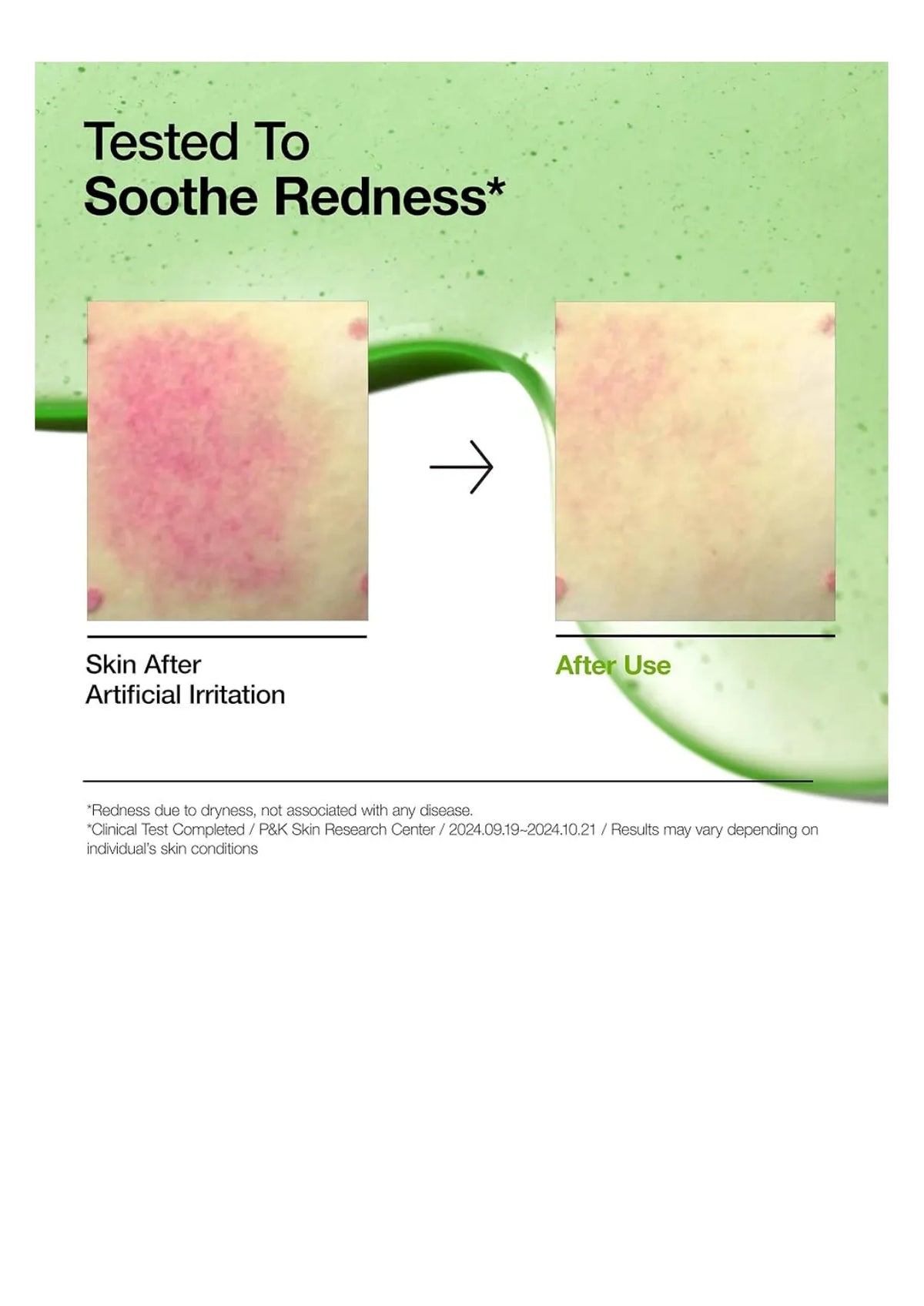 Anua Azelaic Acid 10 + Hyaluron Redness Soothing Serum 30 ml, أنوا سيروم أزيلايك أسيد 10 + هيالورون لتهدئة الاحمرار 30 مل