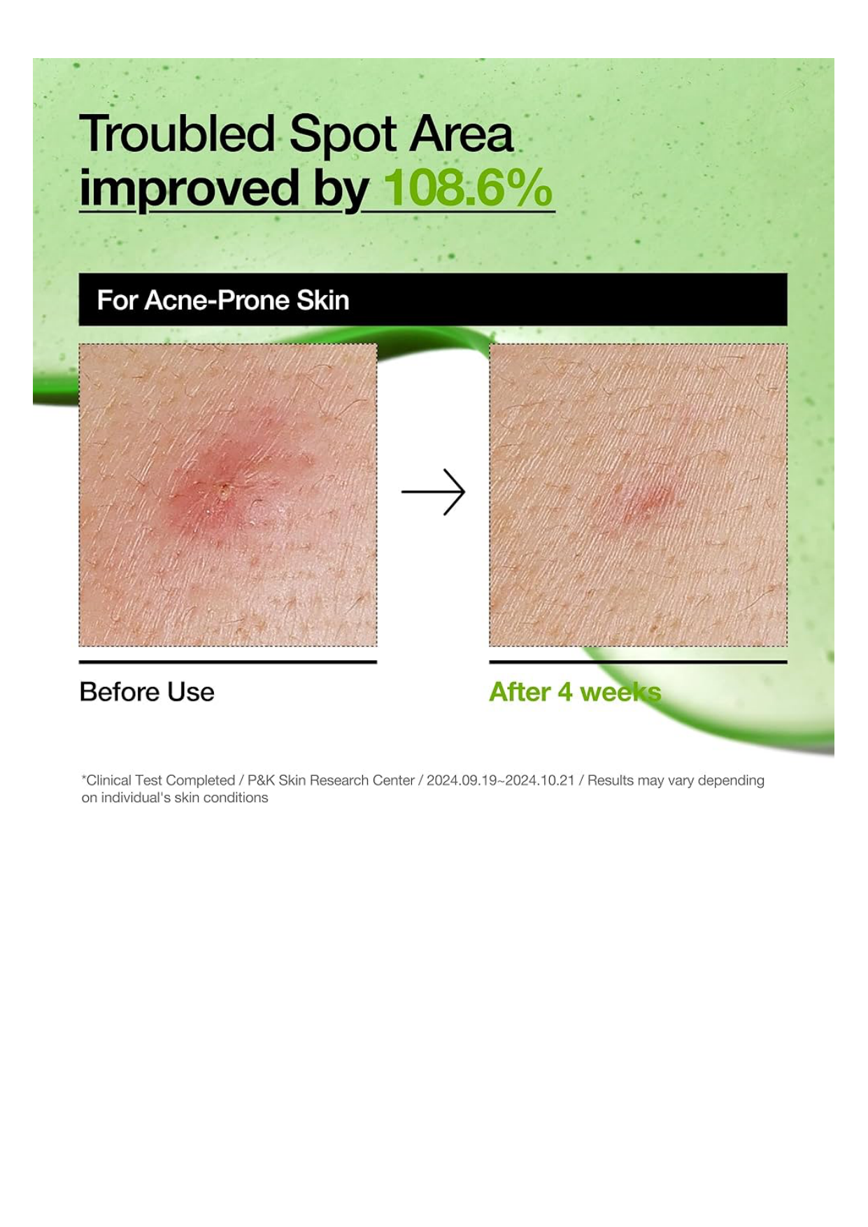 Anua AZELAIC ACID 10+ HYALURON