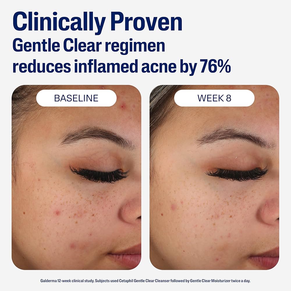 Cetaphil Gentle Clear Mattifying Acne Moisturizer