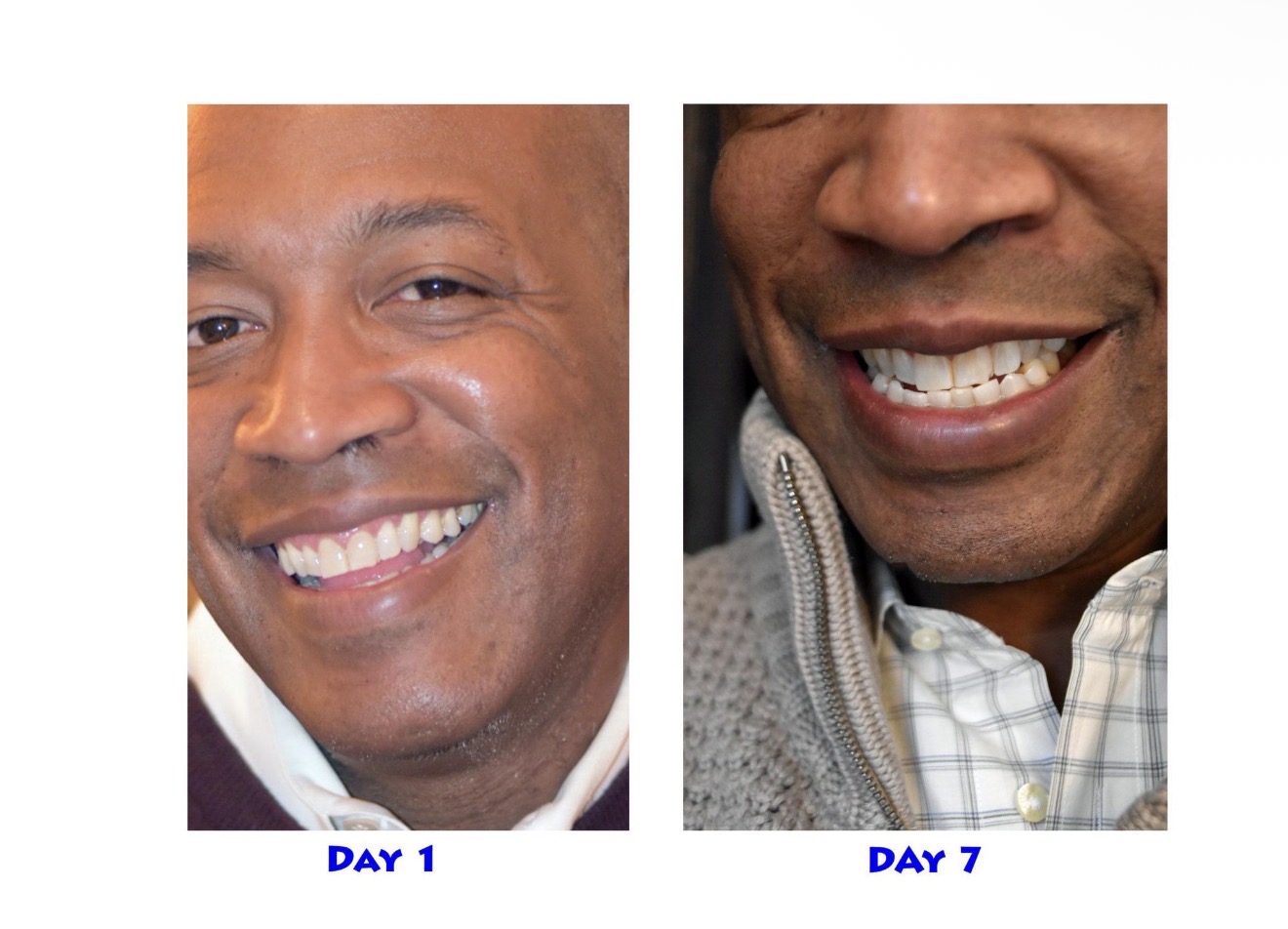 Crest 3D Whitestrips levels 8 in 1 week