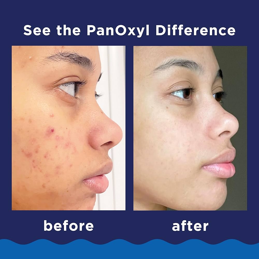 Panoxyl 10% Acne Treatment Gel